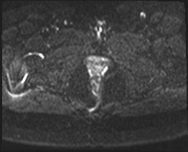 Adnexal multilocular cyst (O-RADS US 3- O-RADS MRI 3) (Radiopaedia 87426-103754 Axial DWI 24).jpg