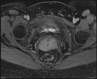 File:Adnexal multilocular cyst (O-RADS US 3. O-RADS MRI 3) (Radiopaedia 87426-103754 Axial 242).jpeg