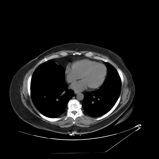 Adrenal angiosarcoma (Radiopaedia 81081-94671 Axial non-contrast 2).jpg