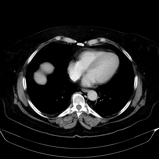 Adrenal cortical carcinoma (Radiopaedia 64017-72769 Axial C+ portal venous phase 1).jpg
