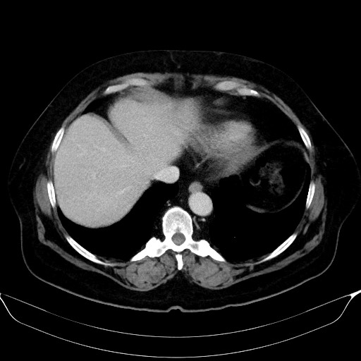 Adrenal cortical carcinoma (Radiopaedia 64017-72769 Axial C+ portal venous phase 7).jpg