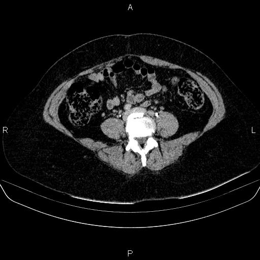 Adrenal cortical carcinoma (Radiopaedia 84882-100379 Axial C+ delayed 59).jpg