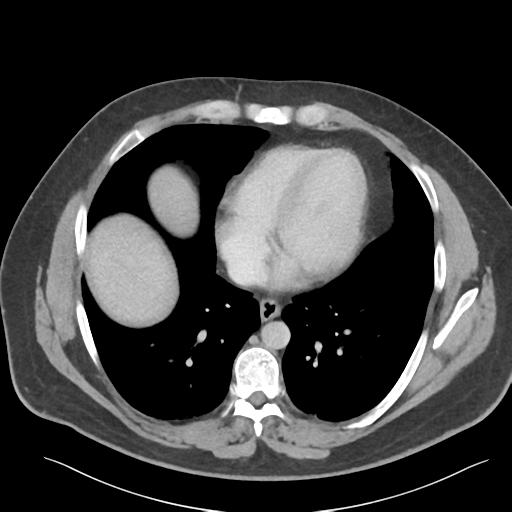 File:Adrenal cyst (Radiopaedia 45625-49777 Axial C+ portal venous phase 10).png