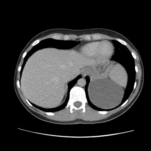 Adrenal cyst (Radiopaedia 64869-73813 Axial C+ portal venous phase 14).jpg
