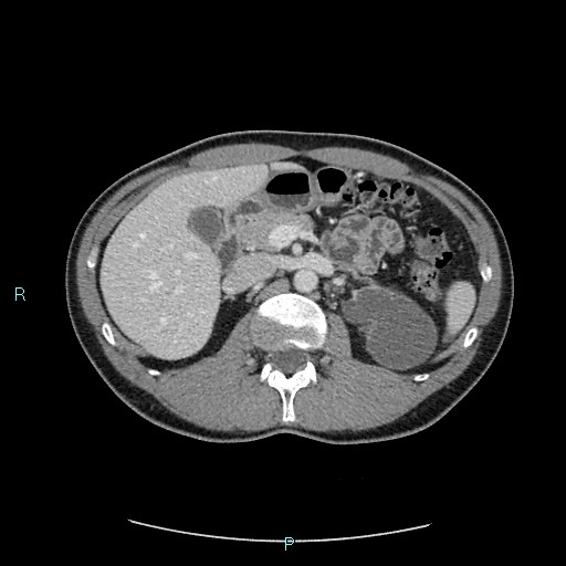 File:Adrenal cystic lymphangioma (Radiopaedia 83161-97534 Axial C+ portal venous phase 33).jpg