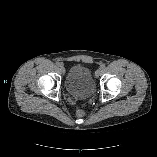 Adrenal cystic lymphangioma (Radiopaedia 83161-97534 Axial non-contrast 91).jpg