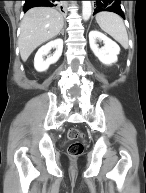 Adrenal hematoma (Radiopaedia 44334-47968 Coronal C+ portal venous phase 37).png