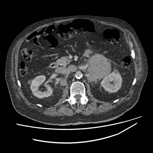 Adrenal lymphoma (Radiopaedia 84145-99415 Axial C+ portal venous phase 51).jpg