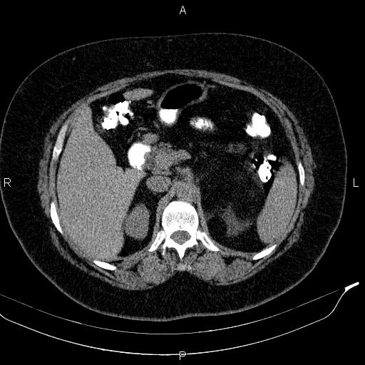 File:Adrenal myelolipoma (Radiopaedia 84319-99617 Axial With oral contrast 71).jpg
