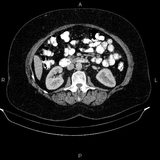 Adrenal myelolipoma (Radiopaedia 84319-99617 Axial renal cortical phase 53).jpg