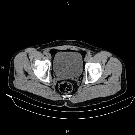 Adrenal myelolipoma (Radiopaedia 87794-104246 Axial non-contrast 98).jpg