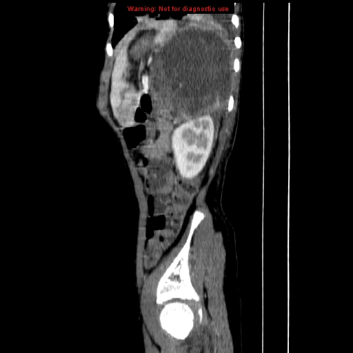 File:Adrenocortical carcinoma (Radiopaedia 9449-10131 Sagittal C+ portal venous phase 16).jpg