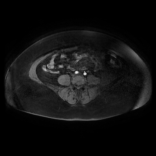File:Adult granulosa cell tumor of the ovary (Radiopaedia 64991-73953 axial-T1 Fat sat post-contrast dynamic 17).jpg