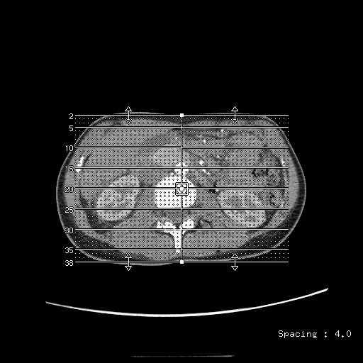 File:Adult polycystic kidney disease (Radiopaedia 48845-53876 Coronal renal cortical phase 1).jpg