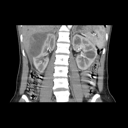 File:Adult polycystic kidney disease (Radiopaedia 48845-53876 Coronal renal cortical phase 23).jpg