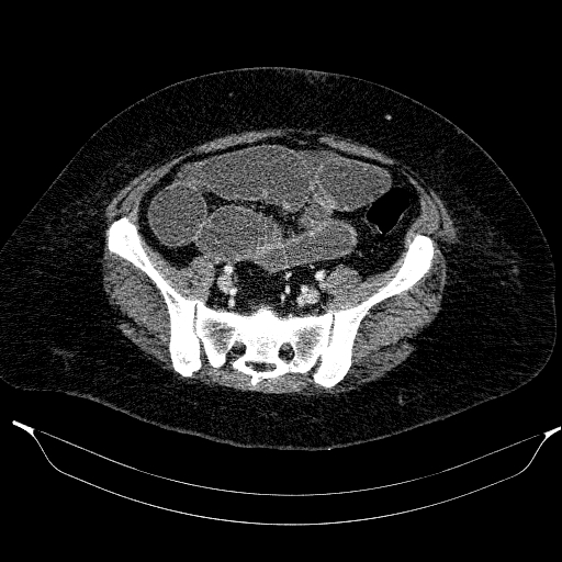 File:Afferent loop syndrome - secondary to incarcerated trocar site hernia (Radiopaedia 82959-97305 Axial C+ portal venous phase 178).jpg
