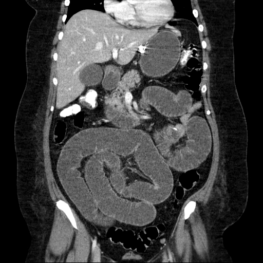 File:Afferent loop syndrome - secondary to incarcerated trocar site hernia (Radiopaedia 82959-97305 Coronal C+ portal venous phase 69).jpg