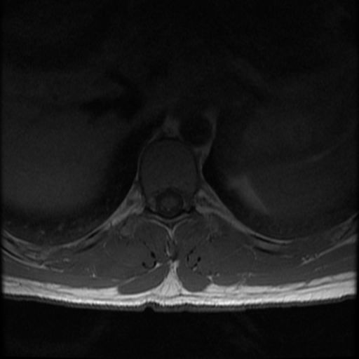 File:Aggressive vertebral hemangioma (Radiopaedia 39937-42404 Axial T1 12).png