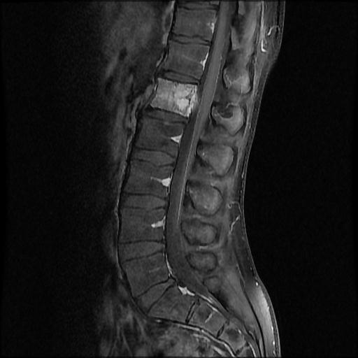 File:Aggressive vertebral hemangioma with pathological fracture (Radiopaedia 69528-79411 F 5).jpg