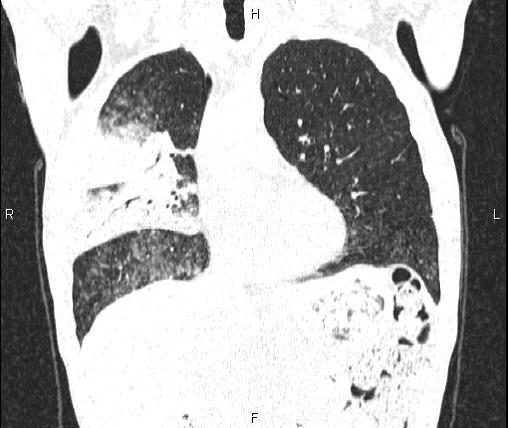Air bronchogram in pneumonia (Radiopaedia 85719-101512 Coronal lung window 23).jpg