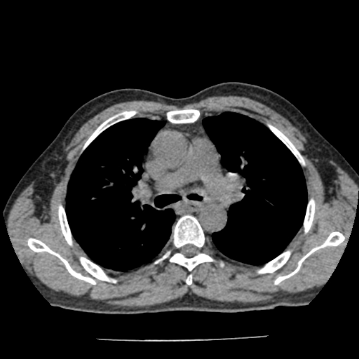Airway foreign body in adult (Radiopaedia 85907-101779 Axial liver window 61).jpg