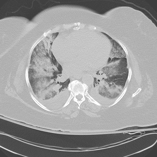 All trans retinoic acid (ATRA) syndrome (Radiopaedia 38212-40229 Axial lung window 33).jpg