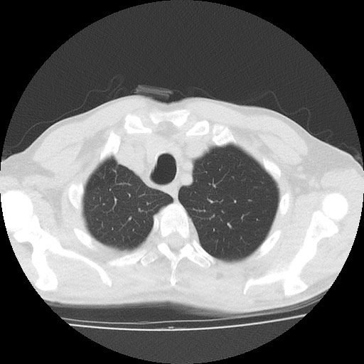Allergic bronchopulmonary aspergillosis (ABPA) (Radiopaedia 60594-68313 Axial lung window 8).jpg