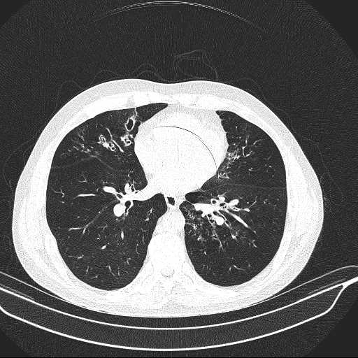 File:Allergic bronchopulmonary aspergillosis (Radiopaedia 21386-21320 Axial lung window 23).jpg