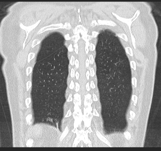 Allergic bronchopulmonary aspergillosis (Radiopaedia 44760-48571 Coronal lung window 49).png