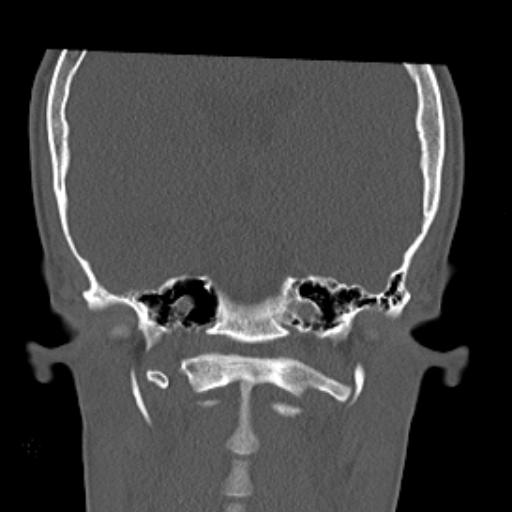 File:Allergic fungal sinusitis (Radiopaedia 29086-29455 Coronal bone window 1).jpg