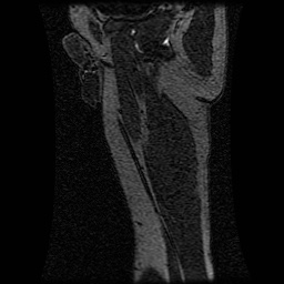 Alveolar soft part sarcoma (Radiopaedia 64501-73678 D 26).jpg