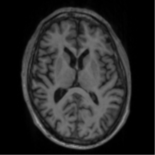 Alzheimer's disease- with apraxia (Radiopaedia 54763-61011 Axial T1 40).png