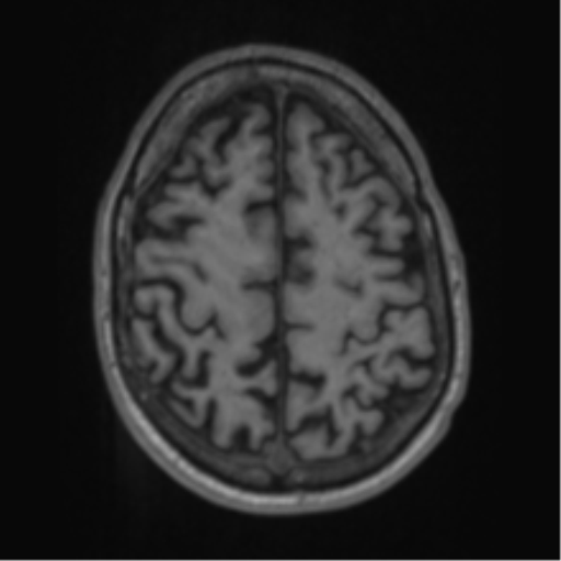 Alzheimer's disease- with apraxia (Radiopaedia 54763-61011 Axial T1 57).png