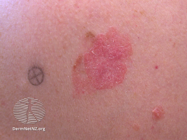 File:Amelanotic melanoma (DermNet NZ amelanotic-melanoma-11).jpg
