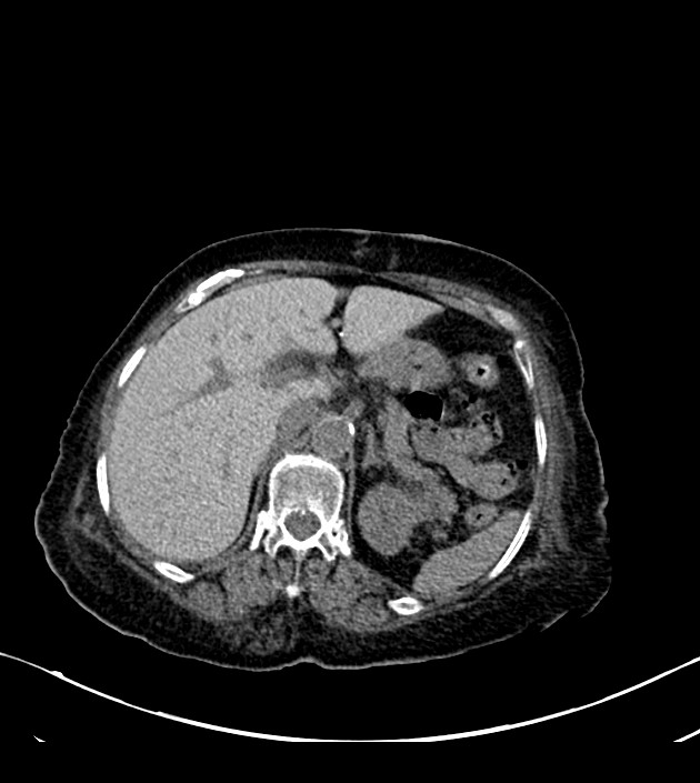 Amiodarone deposition in the liver (Radiopaedia 77587-89780 Axial non-contrast 84).jpg