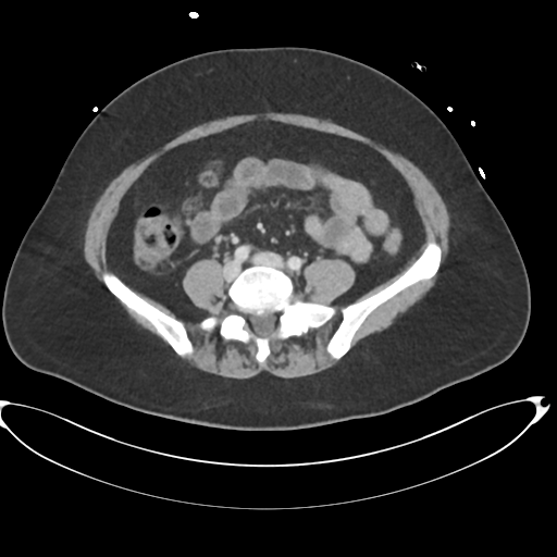 File:Amoebic liver abscess (Radiopaedia 52611-58530 A 66).png