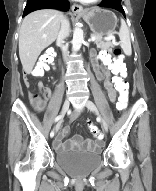 Ampullary adenocarcinoma (Radiopaedia 34013-35237 E 28).png