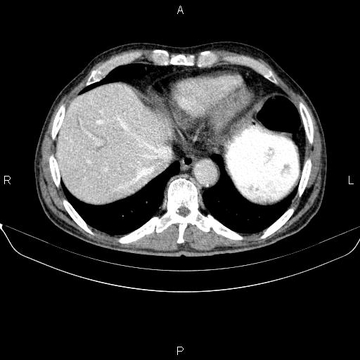 Ampullary adenocarcinoma (Radiopaedia 86093-102032 A 9).jpg