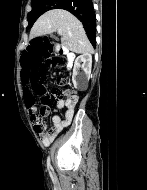 Ampullary adenocarcinoma (Radiopaedia 86093-102032 D 24).jpg