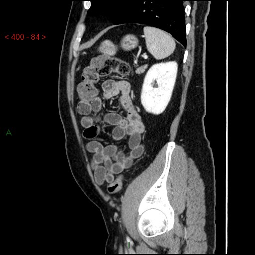 Ampullary carcinoma (Radiopaedia 56396-63056 D 83).jpg