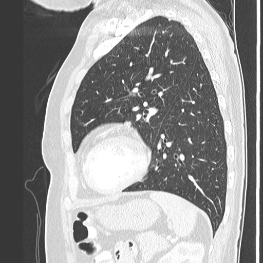 Amyloidosis - bronchial and diffuse nodular pulmonary involvement (Radiopaedia 60156-67745 Sagittal lung window 65).jpg