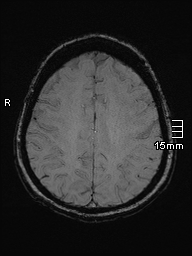 Amyotrophic lateral sclerosis (Radiopaedia 70821-81017 Axial SWI 40).jpg