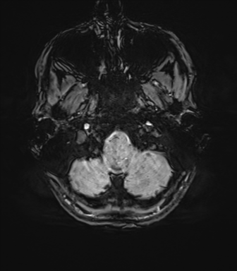 File:Anaplastic astrocytoma IDH mutant (Radiopaedia 50046-55341 Axial SWI 12).png
