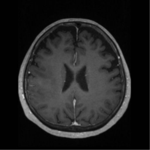 File:Anaplastic astrocytoma IDH wild-type (pseudoprogression) (Radiopaedia 42209-45276 Axial T1 C+ 95).png