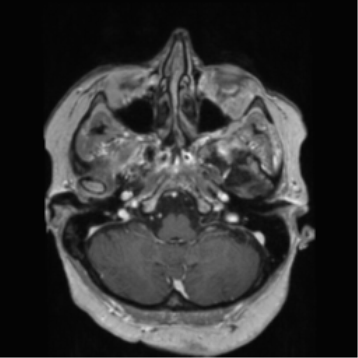 File:Anaplastic astrocytoma IDH wild-type (pseudoprogression) (Radiopaedia 42209-45278 Axial T1 C+ 40).png