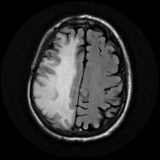 File:Anaplastic meningioma with recurrence (Radiopaedia 34452-35790 Axial T2 FLAIR 16).png