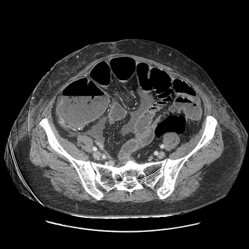 Anastomosis leak at ileostomy closure site (Radiopaedia 82138-96184 B 176).jpg