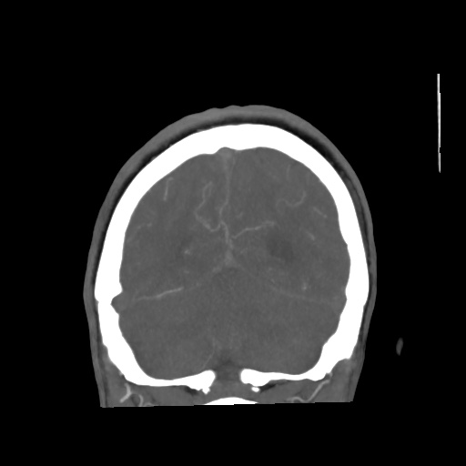 Aneursym related subarachnoid hemorrhage with hydrocephalus (Radiopaedia 45105-49084 B 66).jpg