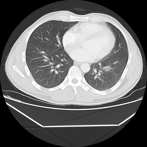 File:Aneurysmal bone cyst - rib (Radiopaedia 82167-96220 Axial lung window 42).jpg