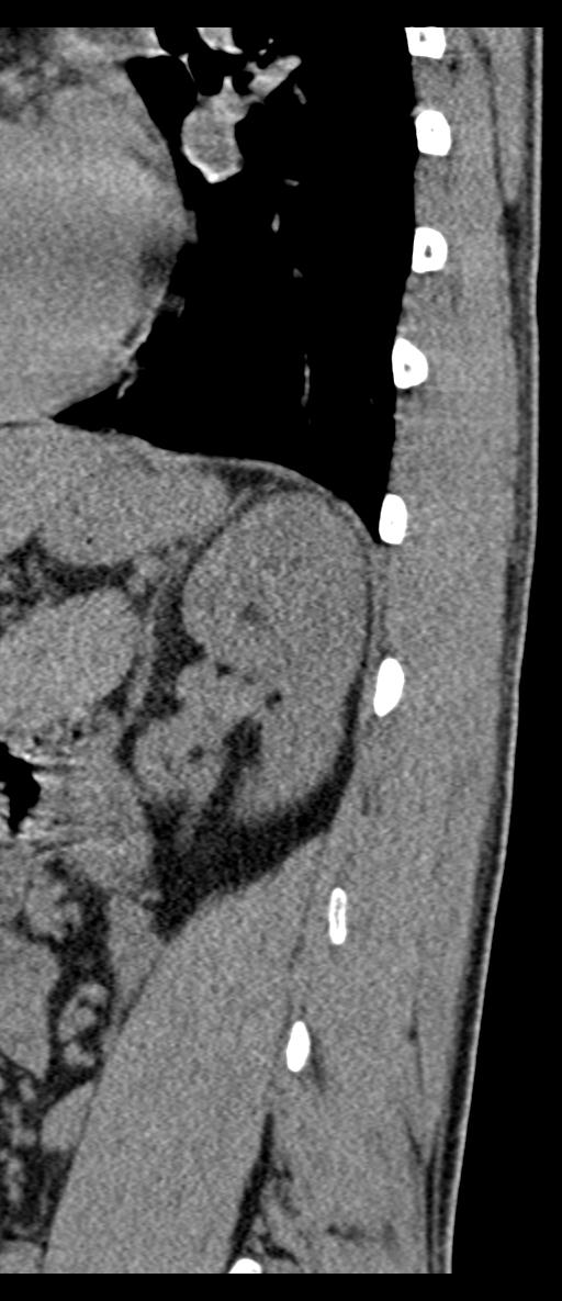 Aneurysmal bone cyst T11 (Radiopaedia 29294-29721 E 11).jpg